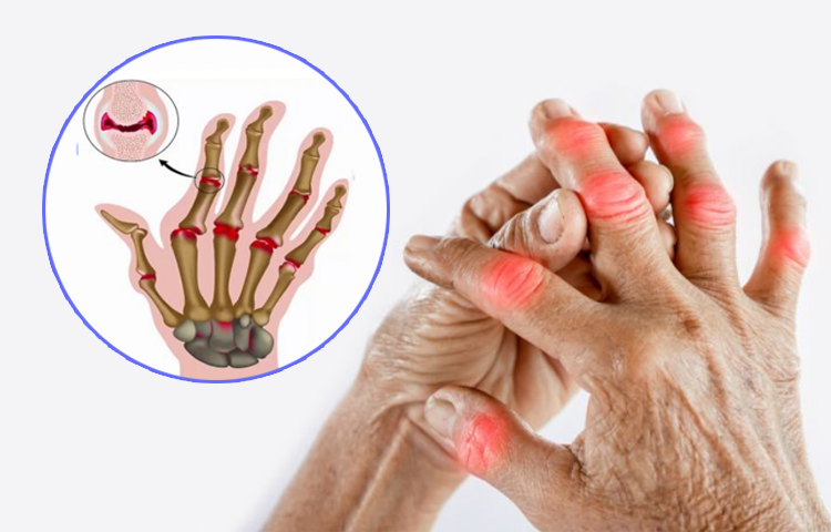 Điều trị viêm khớp dạng thấp (chứng tý) bằng y học cổ truyền